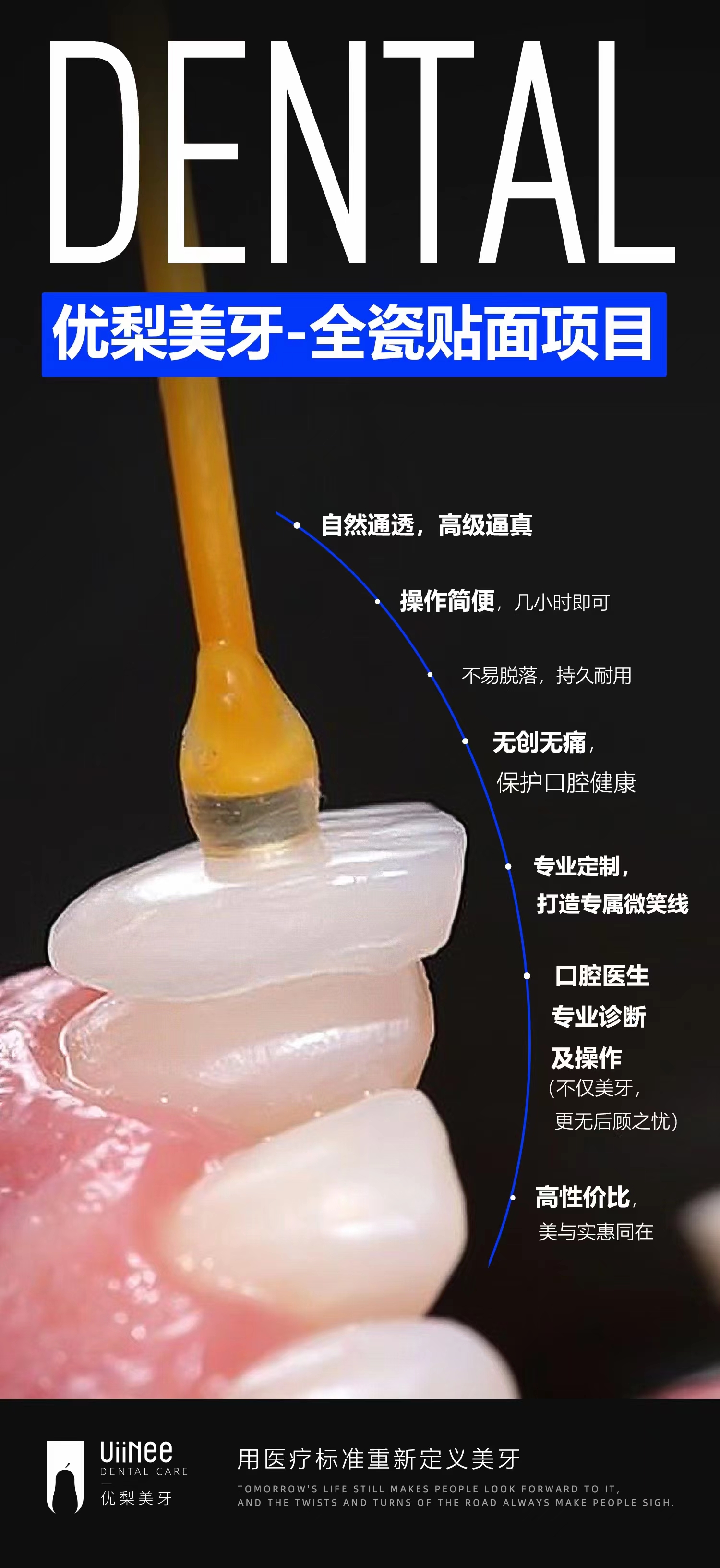 全瓷贴面牙齿美容